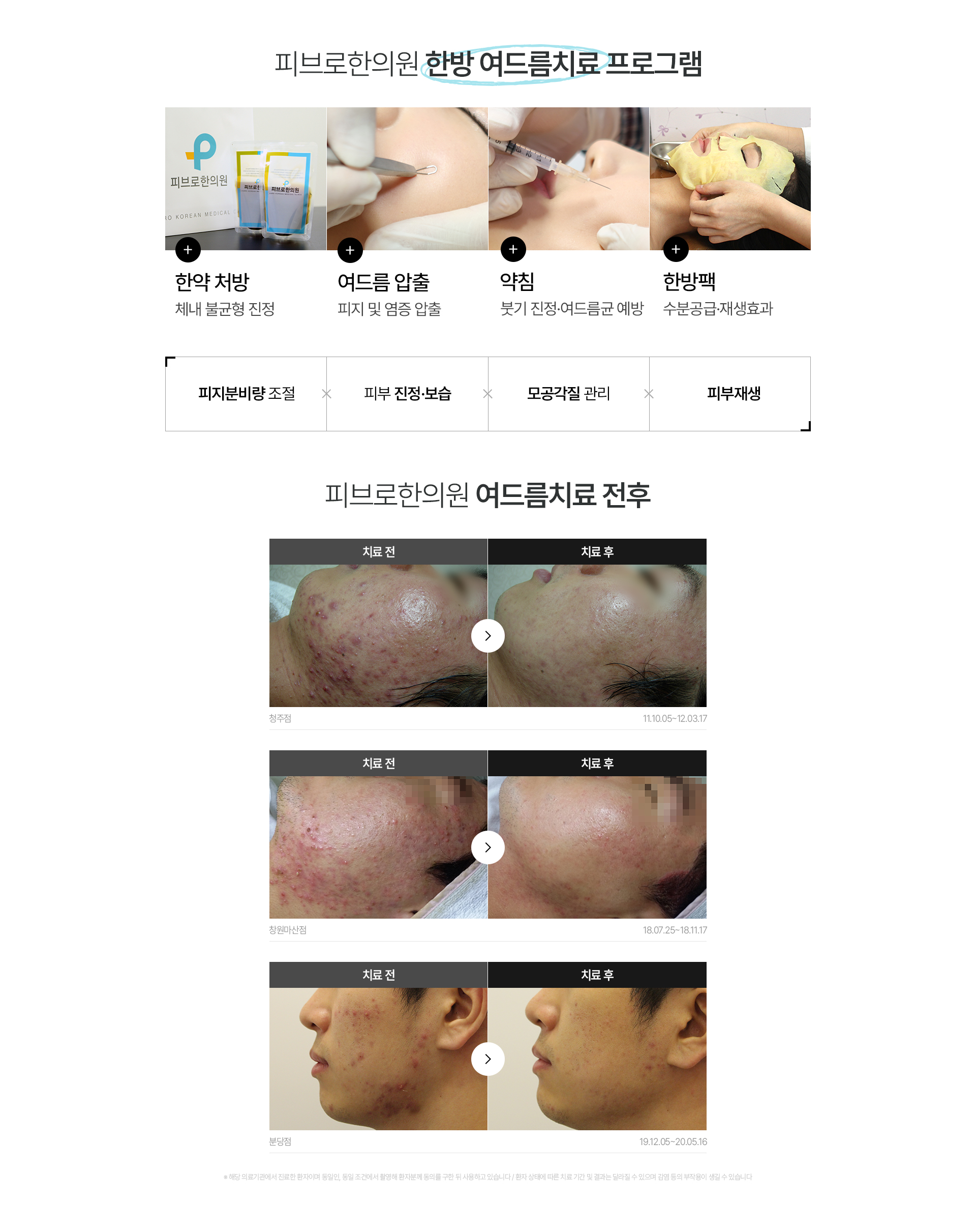 여드름 치료